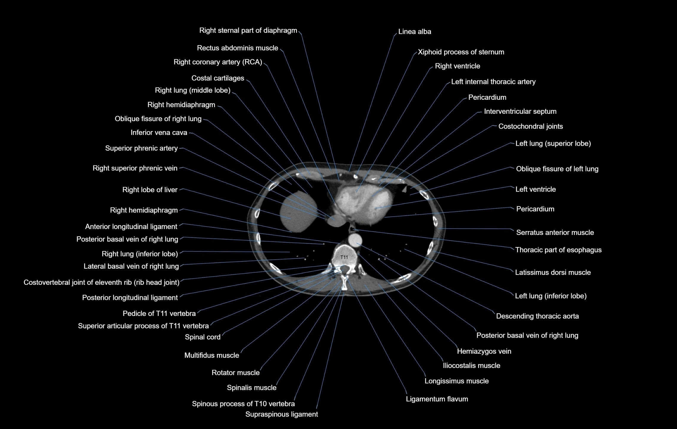 CT chest (thorax) soft tissue window labelled axial cross sectional anatomy radiology image-00096.webp